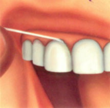Очистка 
промежутков между зубами с помощью зубных нитей